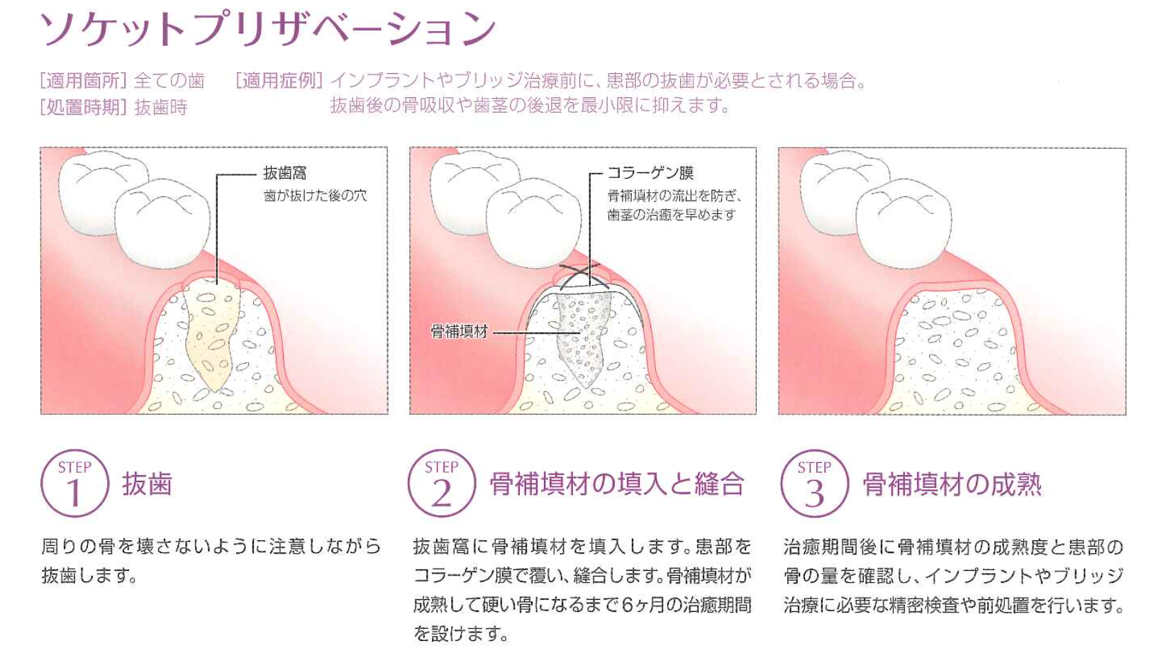 インプラントについて | 新浦安の歯医者・歯科｜栗林歯科医院｜各