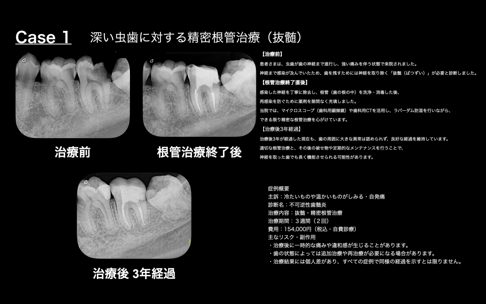 根管治療専門歯科医師による歯内療法（根管治療）専門ページ ~歯を残したいあなたへ~
