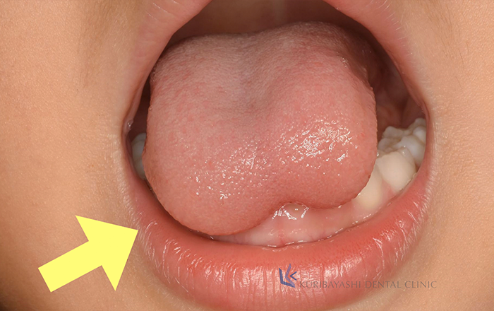 Q.ハート舌って自然に治る？ - 新浦安の歯医者・歯科｜栗林歯科医院｜各専門医在籍